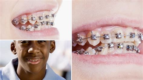 tipos de brackets metalicos autoligables|cómo funcionan los brackets.